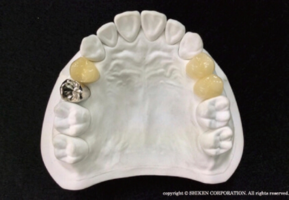 保険適用の拡大で小臼歯部にも使用できます。